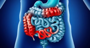 crohn 300x161 - 10 Little Known Uses for CBD